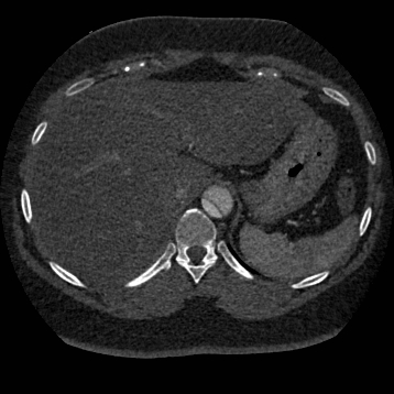 File:Aortic dissection (Radiopaedia 57969-64959 A 291).jpg