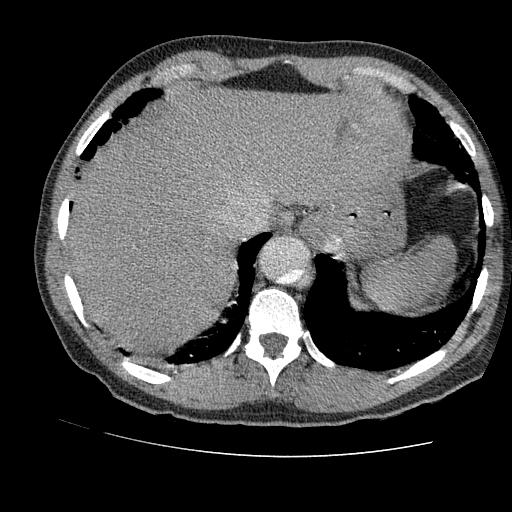 File:Aortic dissection - Stanford A -DeBakey I (Radiopaedia 28339-28587 B 87).jpg