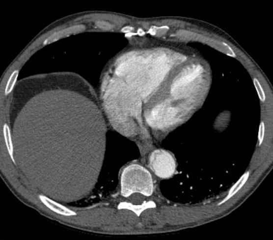 Aortic dissection - Stanford type B (Radiopaedia 73648-84437 A 85).jpg