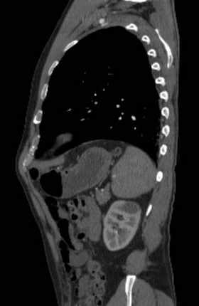 File:Aortic dissection - Stanford type B (Radiopaedia 73648-84437 C 33).jpg