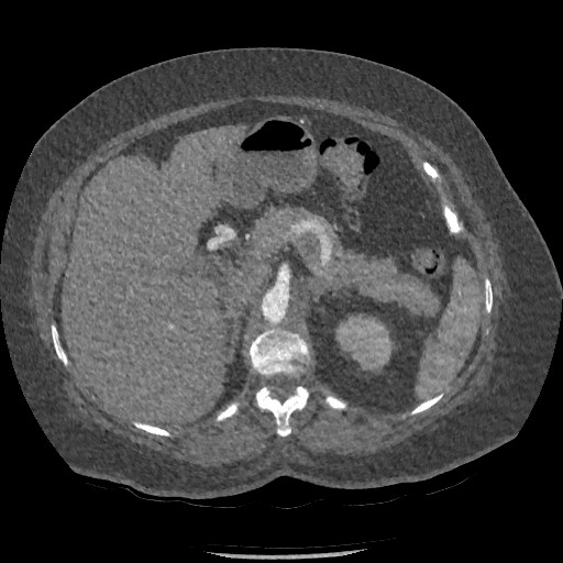 File:Aortic dissection - Stanford type B (Radiopaedia 88281-104910 A 106).jpg