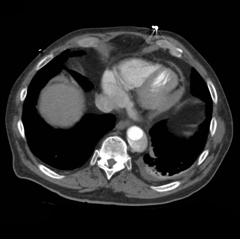 Aortic dissection with rupture into pericardium (Radiopaedia 12384-12647 A 44).jpg