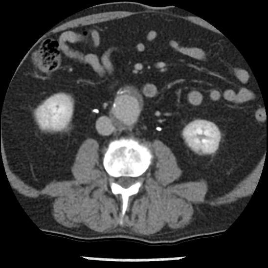 File:Aortic intramural hematoma (type B) (Radiopaedia 79323-92387 Axial C+ delayed 76).jpg