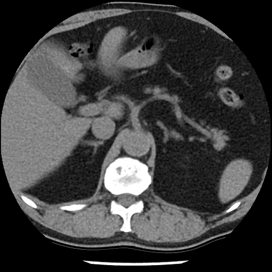 Aortic intramural hematoma (type B) (Radiopaedia 79323-92387 Axial non-contrast 57).jpg
