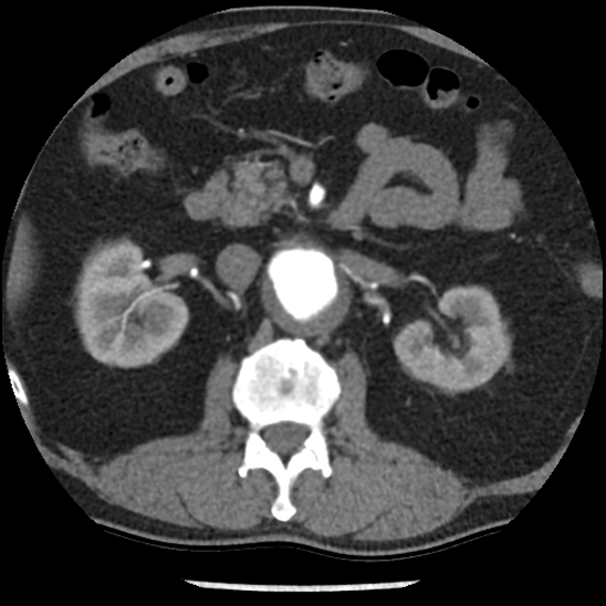 File:Aortic intramural hematoma (type B) (Radiopaedia 79323-92387 B 66).jpg
