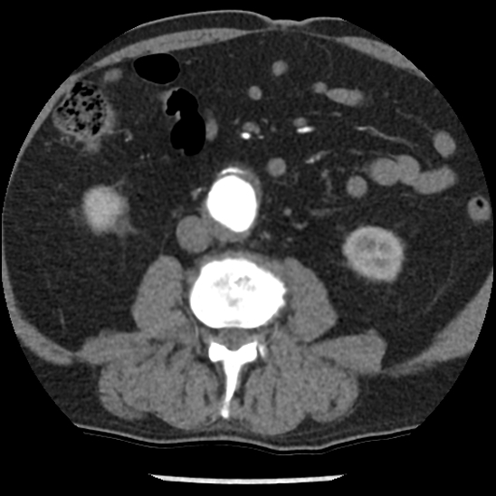 Aortic intramural hematoma (type B) (Radiopaedia 79323-92387 B 77).jpg