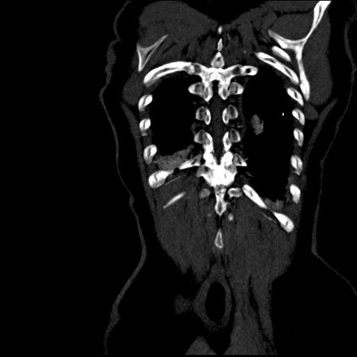 Aortic intramural hematoma from penetrating atherosclerotic ulcer (Radiopaedia 31137-31836 C 61).jpg