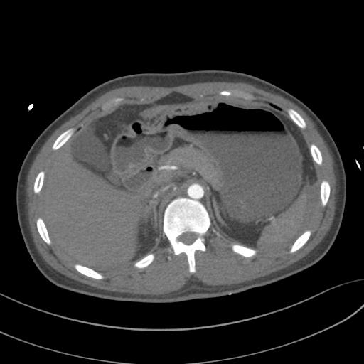File:Aortic transection (Radiopaedia 29890-30405 A 99).jpg