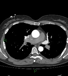 Aortic valve endocarditis (Radiopaedia 87209-103485 C 42).jpg