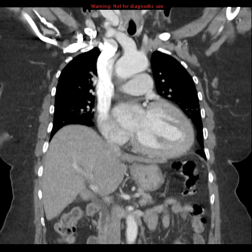 File:Aortic valve stenosis (Radiopaedia 14480-14423 A 11).jpg