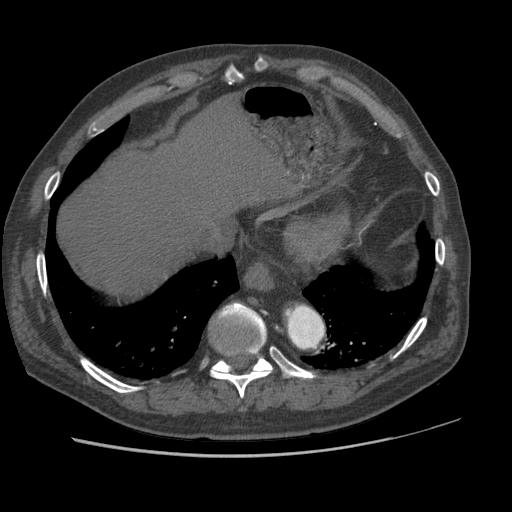 File:Aorto-coronary bypass graft aneurysms (Radiopaedia 40562-43157 A 100).png