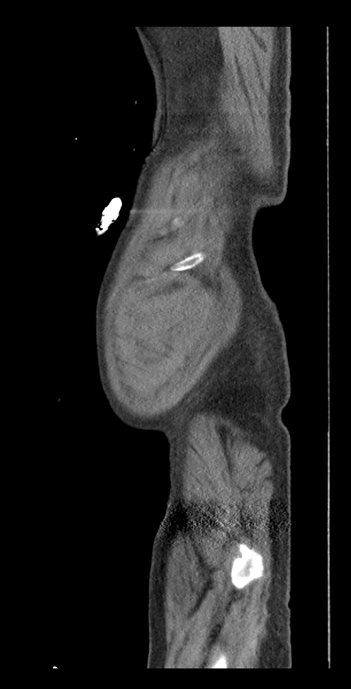 Aortoduodenal fistula (Radiopaedia 75286-86415 Sagittal C+ delayed 63).jpg