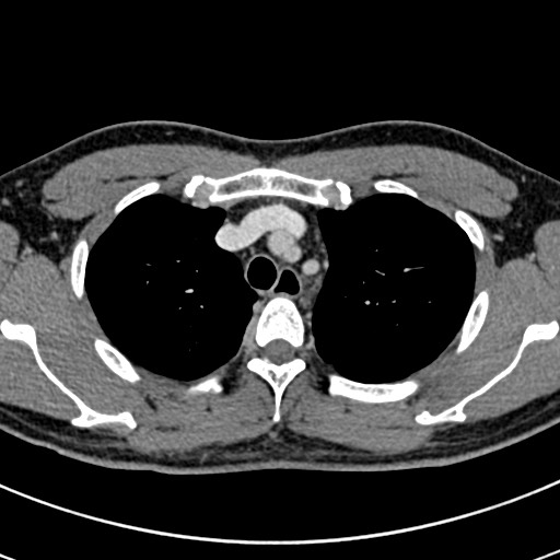 File:Apical lung mass mimic - neurogenic tumor (Radiopaedia 59918-67521 A 20).jpg