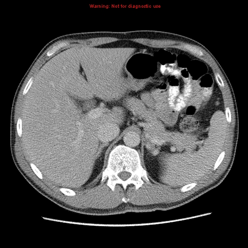 Appendicitis and renal cell carcinoma (Radiopaedia 17063-16760 A 13).jpg