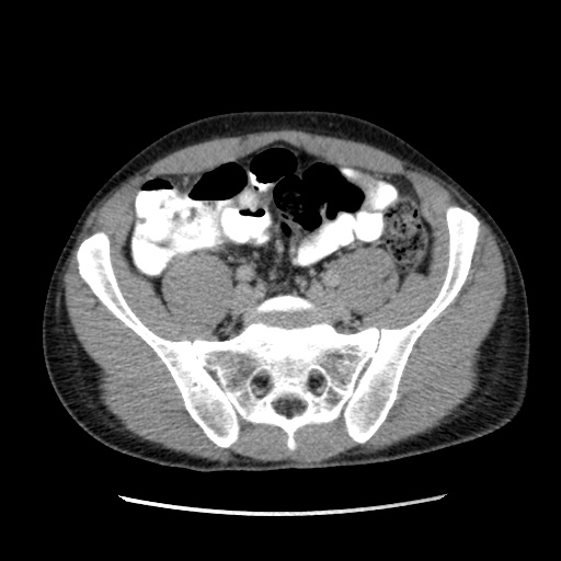 File:Appendicitis complicated by post-operative collection (Radiopaedia 35595-37113 A 55).jpg