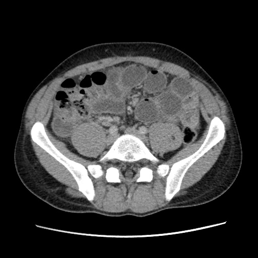 File:Appendicitis complicated by post-operative collection (Radiopaedia 35595-37114 A 58).jpg