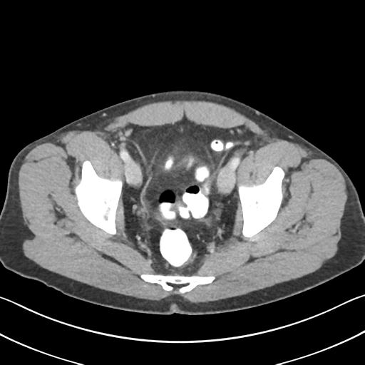 File:Appendicitis with cecal bar sign (Radiopaedia 31878-32830 B 71).jpg