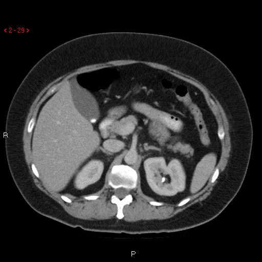 Appendicitis with microperforation- promontoric type (Radiopaedia 27268-27442 C 17).jpg