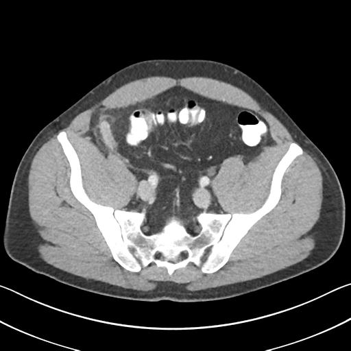 Appendicitis with thickening of the terminal ileum (Radiopaedia 42432-45550 A 32).jpg