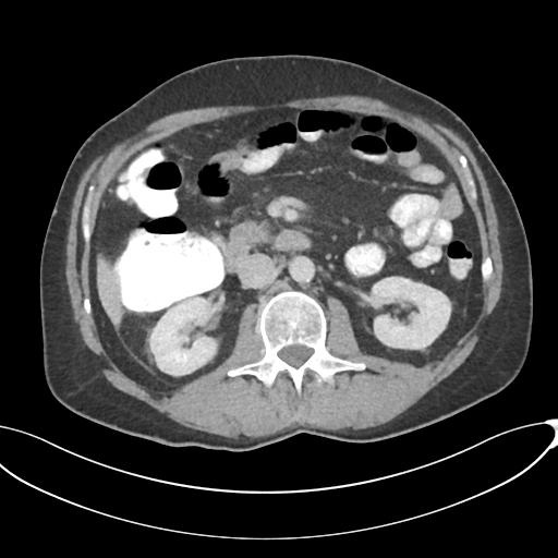 Appendicitis with thickening of the terminal ileum (Radiopaedia 42432-45550 A 42).png
