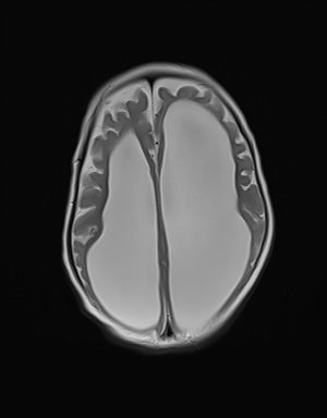 File:Aqueductal stenosis (Radiopaedia 73974-84802 Axial T2 16).jpg