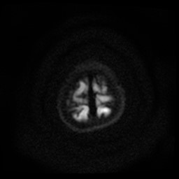 Arachnoid cyst - middle cranial fossa (Radiopaedia 86780-102938 Axial DWI 2).jpg