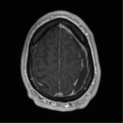 Arachnoid cyst with subdural hematoma (Radiopaedia 85892-101743 Axial T1 C+ 70).png