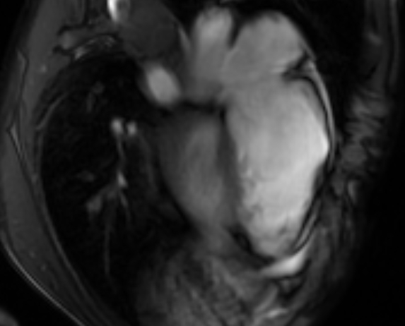 Arrhythmogenic right ventricular cardiomyopathy (Radiopaedia 69564-79464 4ch cine 109).jpg
