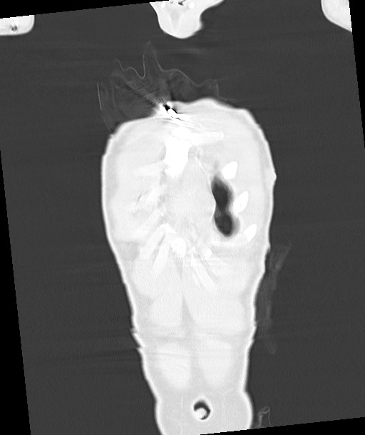 Arrow injury to the chest (Radiopaedia 85367-100975 Coronal lung window 39).jpg