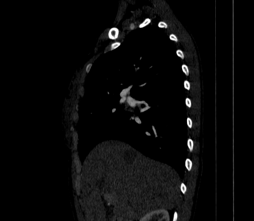 Arteria lusoria (Radiopaedia 88528-105192 C 37).jpg