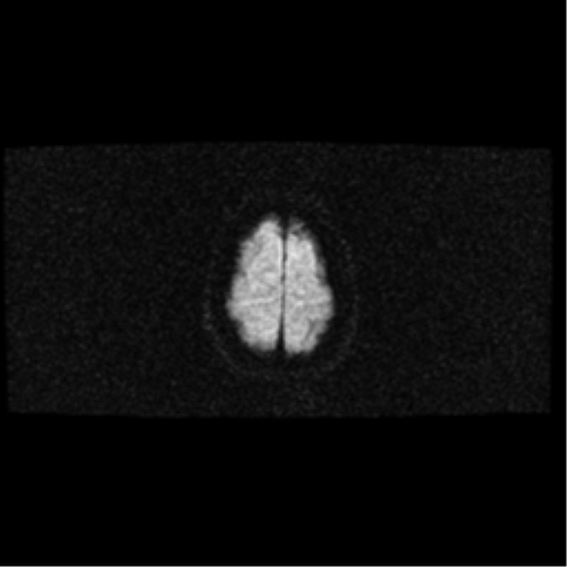 File:Arteriovenous malformation (cerebral) (Radiopaedia 40070-42580 Axial DWI 20).png