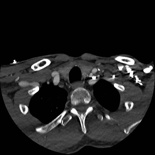 Artery of Percheron infarct (Radiopaedia 48088-52894 A 28).jpg