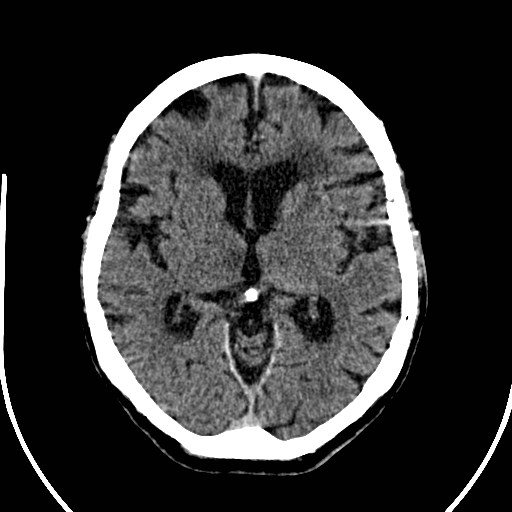 File:Artery of Percheron infarction (Radiopaedia 26307-26438 Axial non-contrast 17).jpg