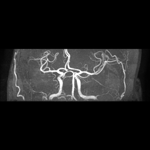 Artery of Percheron infarction (Radiopaedia 27975-28230 3D TOF 9).jpg
