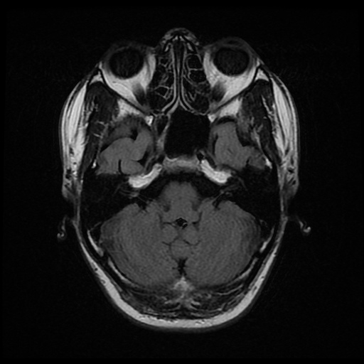 File:Artery of Percheron infarction (Radiopaedia 27975-28230 Axial FLAIR 7).jpg