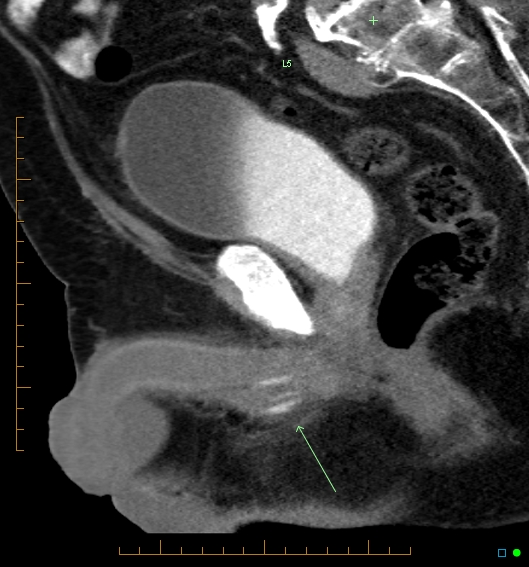File:Artificial urethral sphincter (Radiopaedia 46937-51464 Sagittal C+ delayed 21).jpg