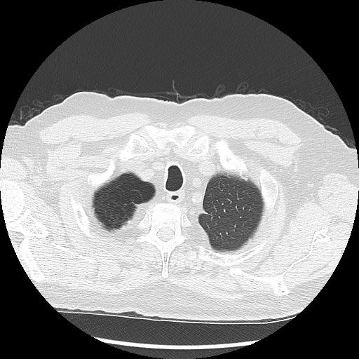 Asbestos-related pleural disease (Radiopaedia 74366-85250 Axial lung window 16).jpg