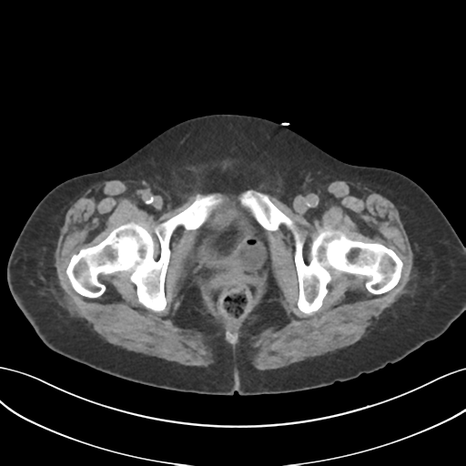 File:Ascending cholangitis (Radiopaedia 39068-41253 Axial non-contrast 67).png