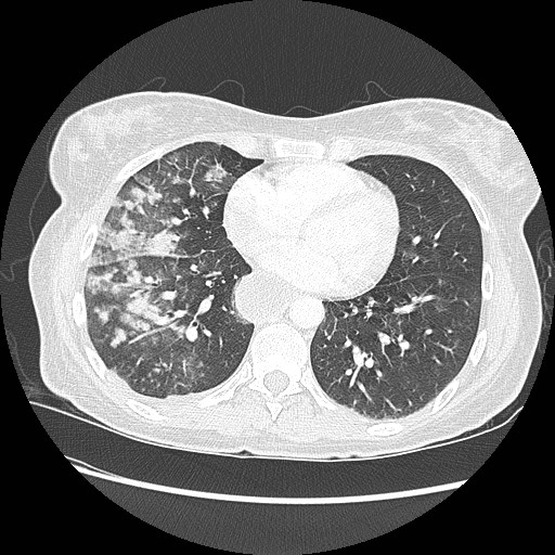 Aspiration pneumonia secondary to laparoscopic banding (Radiopaedia 18345-18183 lung window 71).jpg