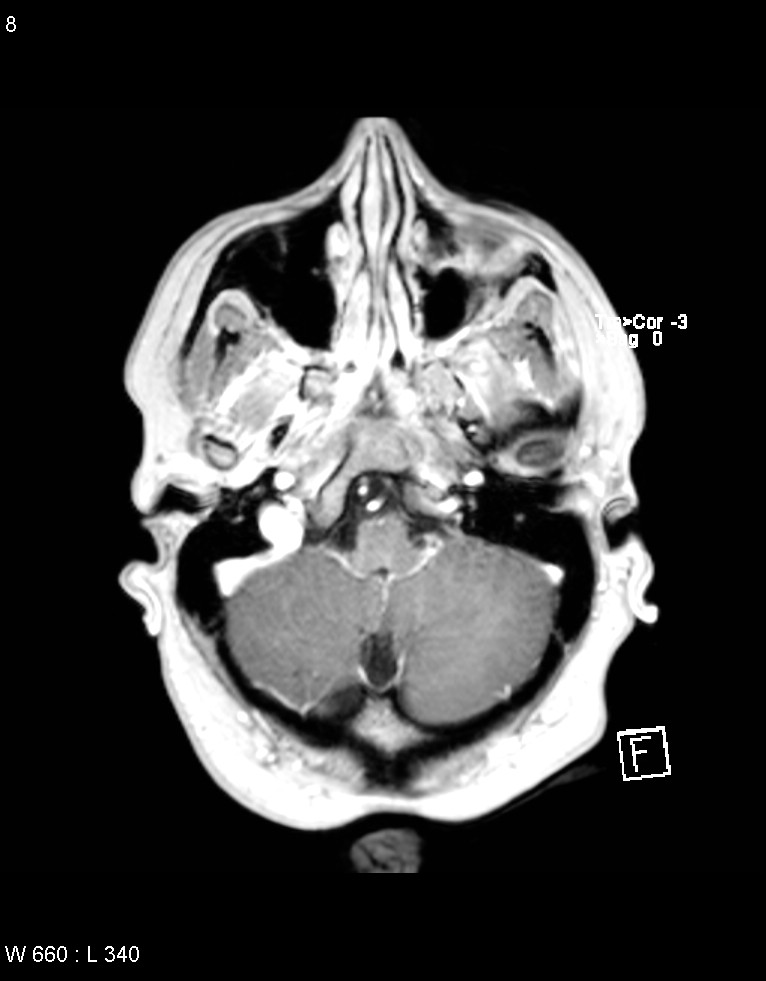 Astroblastoma (Radiopaedia 39792-42218 Axial T1 C+ 7).jpg