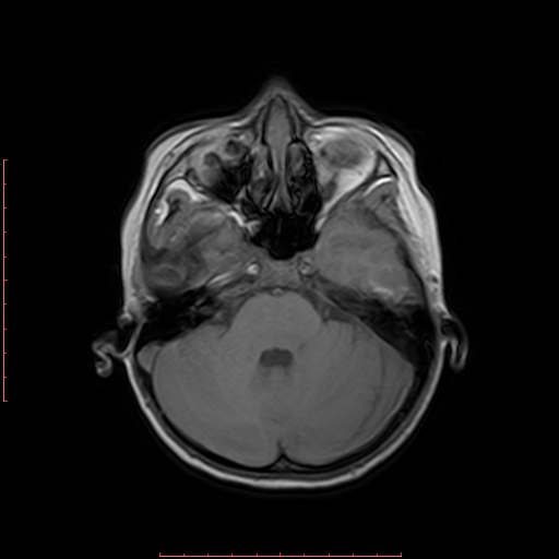 File:Astroblastoma (Radiopaedia 74287-85162 Axial T1 5).jpg