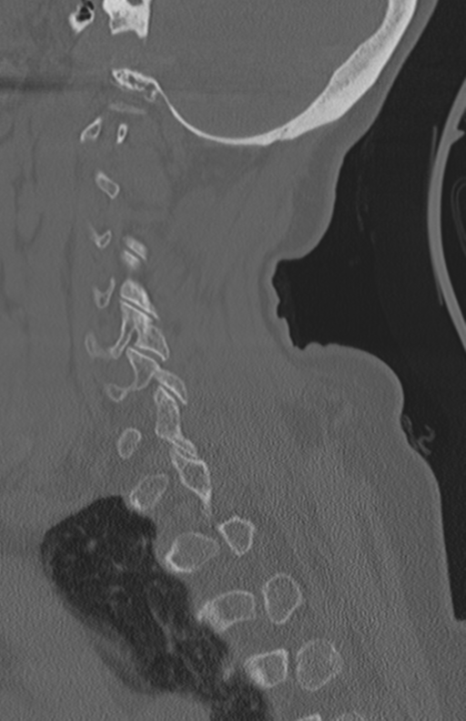 Atlanto-axial subluxation (Radiopaedia 36610-38176 Sagittal bone window 57).png