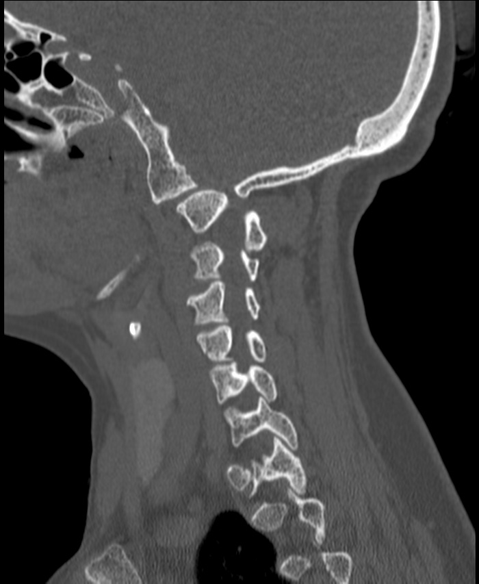 Atlanto-occipital assimilation with basilar invagination (Radiopaedia 70122-80188 Sagittal bone window 24).jpg