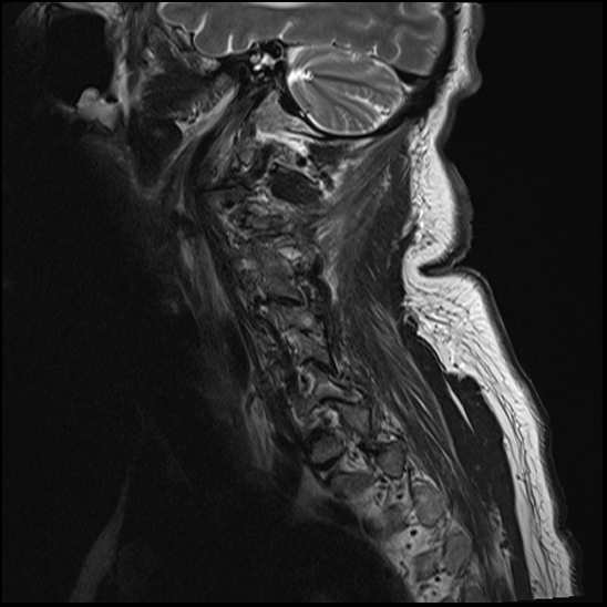 File:Atlas (type 3b subtype 1) and axis (Anderson and D'Alonzo type 3, Roy-Camille type 2) fractures (Radiopaedia 88043-104610 Sagittal T2 13).jpg