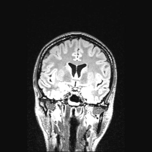 Atretic encephalocoele with inferior vermis hypoplasia (Radiopaedia 30443-31108 Coronal FLAIR 109).jpg