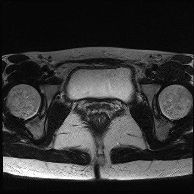 File:Atypical deep infiltrating endometriosis (Radiopaedia 44470-48125 Axial T2 24).jpg