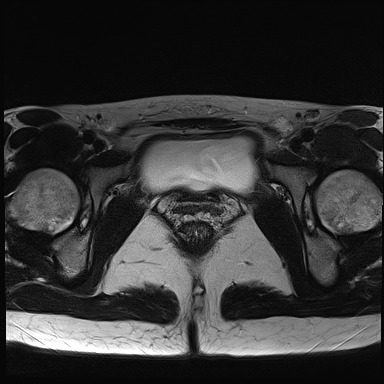File:Atypical deep infiltrating endometriosis (Radiopaedia 44470-48125 Axial T2 25).jpg