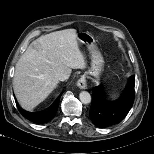 Atypical hepatocellular carcinoma (Radiopaedia 41744-44698 B 15).jpg