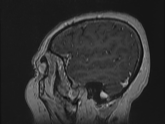 Atypical meningioma (Radiopaedia 62985-71406 Sagittal T1 C+ 10).jpg