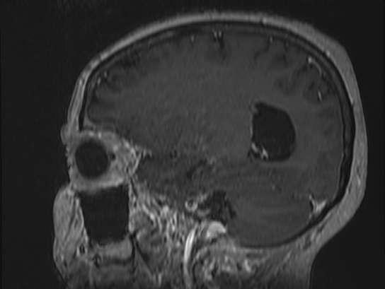 Atypical meningioma (Radiopaedia 62985-71406 Sagittal T1 C+ 25).jpg